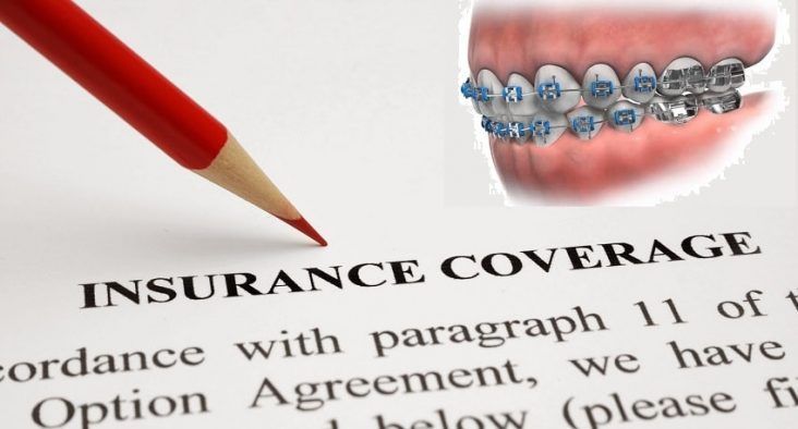 Can insurance cover braces